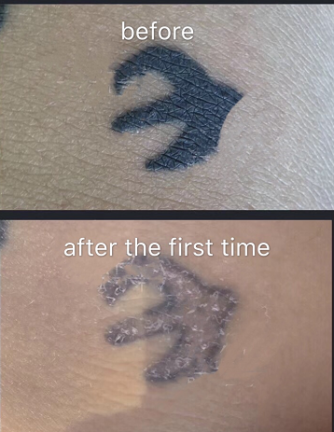 YD Pigment Removal&YD Removal Solution - CharmingTattooSupply