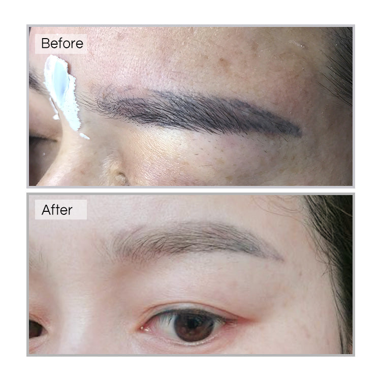 YD Pigment Removal&YD Removal Solution - CharmingTattooSupply