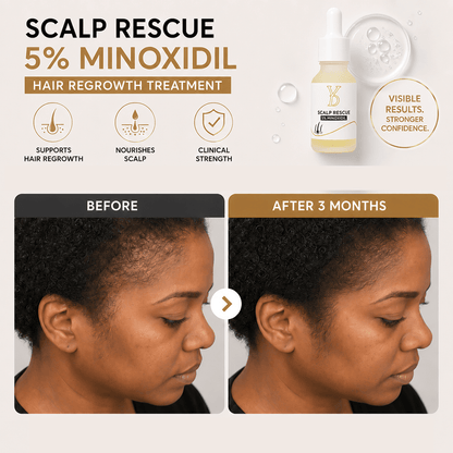 5% Minoxidil Topical Solution – YDPMU Scalp Rescue 15ml